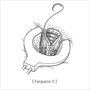 high_ligation_and_complete_closure03.jpg