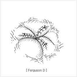high_ligation_and_complete_closure04.jpg