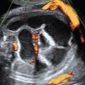 hirschsprung_disease_5229.png