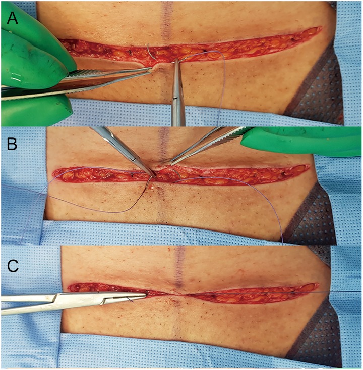 To achieve an even distribution of tension, the wound edges were approximated with interrupt buried intradermal sutures at 1 cm intervals of 3–0 Vicryl (A-C).