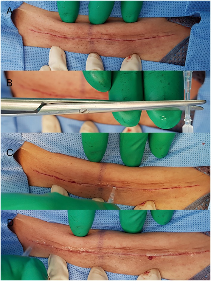 In cases of tissue adhesive closure, skin edges was manually approximated (A). Histoacryl was opened by cutting the tip of cannula and activated (B). Histoacryl was applied over approximated wound edges as a thin film. (C, D)