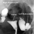 hsg-blocked-fallopian-tubes.jpg