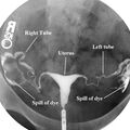 hsg-normal-anatomy.jpg