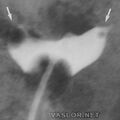 hsg_airbubble_artifact.jpg