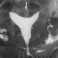 hsg_arcuate_uterus.jpg