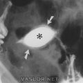 hsg_double_uterine_contour_wnl.jpg
