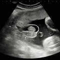 hydrocele_5152.png