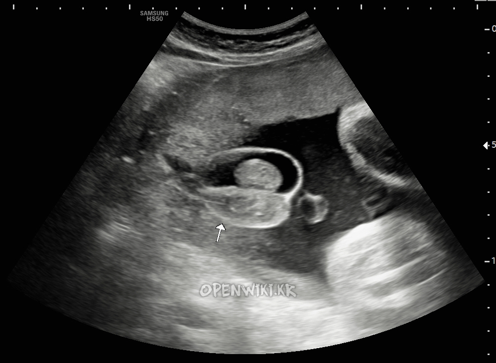 hydrocele_5152.png