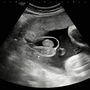 hydrocele_5152.png