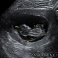 hydrops_fetalis_02.jpg