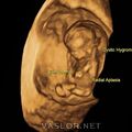 hydrops_fetalis_03.jpg