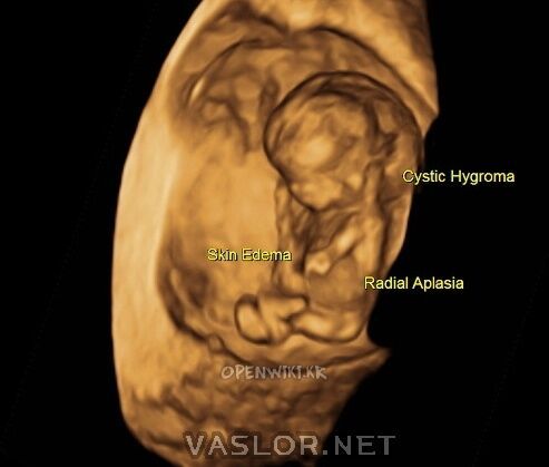 hydrops_fetalis_03.jpg