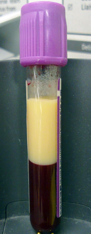 hyperlipidemia_2644.png