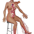 hyperthyroidism.jpg