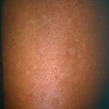 hypomelanosis_igh4-1150.jpg