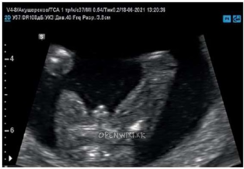 15weeks