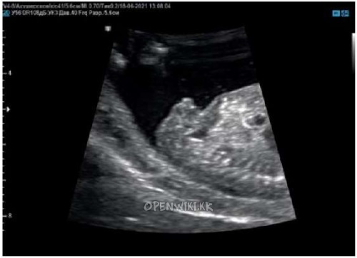 15weeks sagittal 