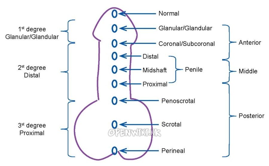 hypospadia_4711.png