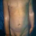 ichthyosis11.jpg