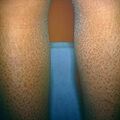 ichthyosis13.jpg