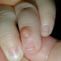 infantiledigitalfibroma011231.jpg