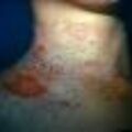infdermatitis22.jpg