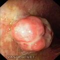 inflammatory_polyp.jpg