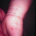 insectbite2000-212.jpg