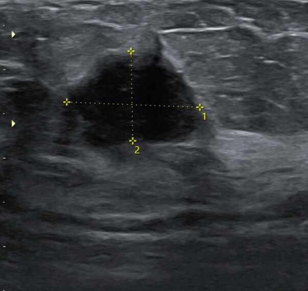 invasivecarcinoma.jpg