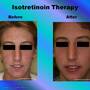isotretinoin-therapy.jpg