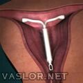 iud.jpg