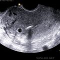 iud2_00007.jpg