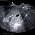 iud_pregnancy_02.jpg