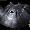 iud_pregnancy_03.jpg
