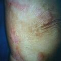 keloid9-730.jpg