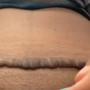 keloid_1442.png