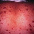 keloidalacne2000-27.jpg