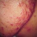 keloidalacne9-967.jpg