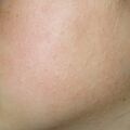 keratosispilaris020511.jpg