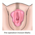 labioplasty_0017.png