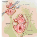 labioplasty_1006180133.png