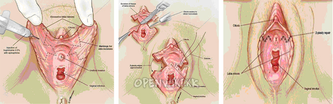 labioplasty_1006180133.png