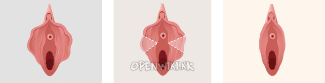 labioplasty_1006180452.png