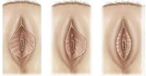 labioplasty_1006180552.png