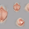 labioplasty_1006180913.png
