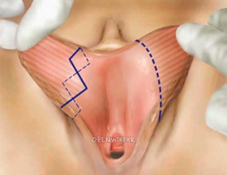 labioplasty_1006181044.png