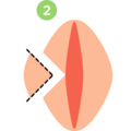 labioplasty_1006181138.png