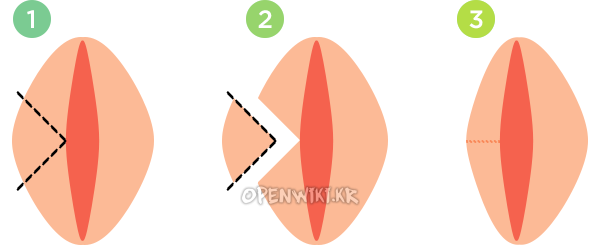 labioplasty_1006181138.png