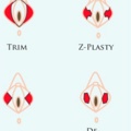 labioplasty_1006181458.png