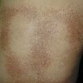 lichenamyloidosis020307-1.jpg